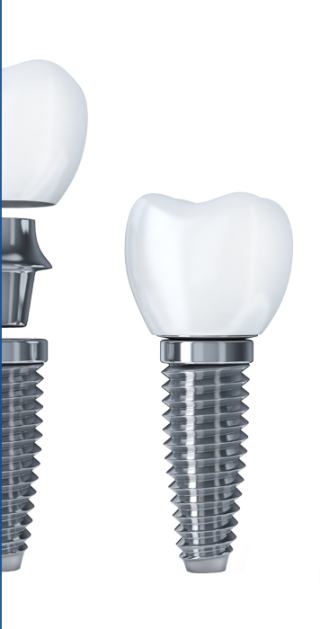 Implantologie Implantologie